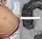 
                  Mulher passa por cirurgia para retirar cocô de 20 quilos do intestino
