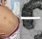 
                  Mulher passa por cirurgia para retirar cocô de 20 quilos do intestino