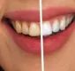
                  Lente contato dental: saiba quais são os riscos do procedimento