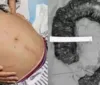 Mulher passa por cirurgia para retirar cocô de 20 quilos do intestino