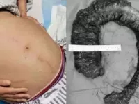 Mulher passa por cirurgia para retirar cocô de 20 quilos do intestino