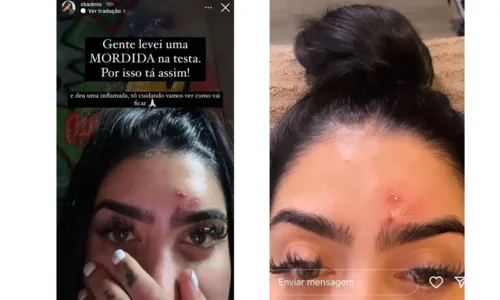 
				
					MC Mirella leva mordida de macaco de estimação na testa: 'Inflamada'
				
				