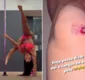 
                  Gracyanne Barbosa fere joelho em aula de pole dance: 'Pele arrancou'