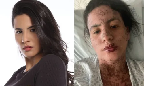 
				
					Esposa de Frank Aguiar desabafa na web após sofrer com doença rara na pele
				
				