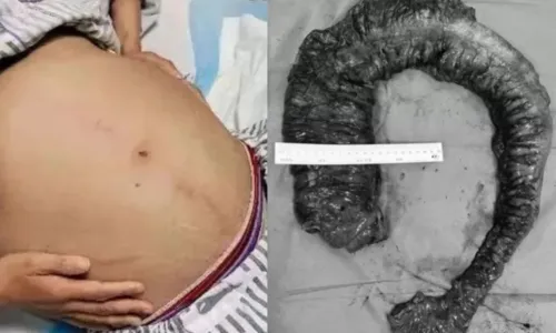 
				
					Mulher passa por cirurgia para retirar cocô de 20 quilos do intestino
				
				