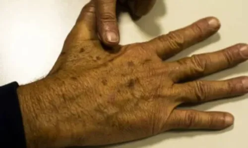 
				
					Mutirão para prevenção ao câncer de pele acontece em Salvador
				
				