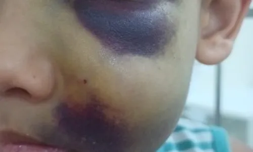 
				
					Criança é internada com hematomas e escola alega acidente na Bahia
				
				