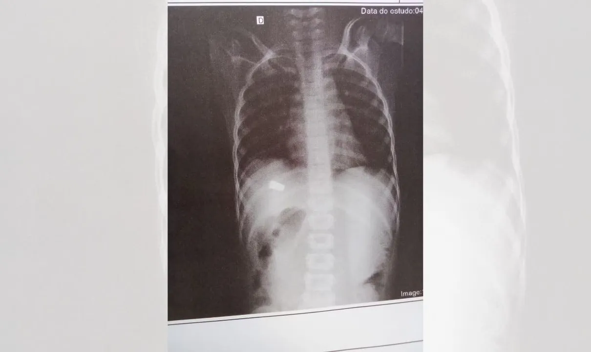 Exame de raio-x mostrou que criança estava baleada