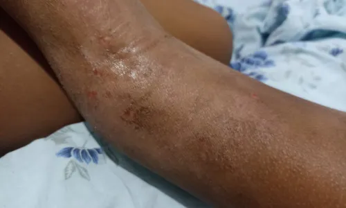 
				
					Família faz vaquinha para tratamento de menina com dermatite grave
				
				