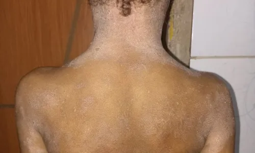 

					Família faz vaquinha para tratamento de menina com dermatite grave

				