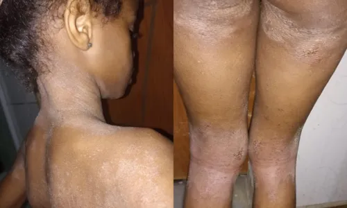 

					Família faz vaquinha para tratamento de menina com dermatite grave

				