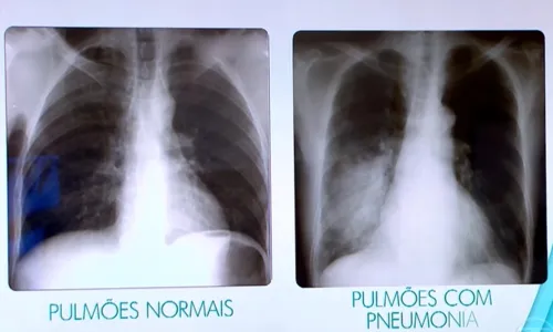 
				
					Mais de 30 mil pessoas foram internadas com pneumonia na Bahia em 2023
				
				
