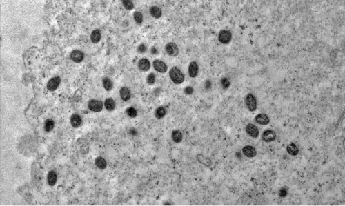 
				
					Mpox: o que é, sintomas, transmissão, tratamentos e cenário na Bahia
				
				