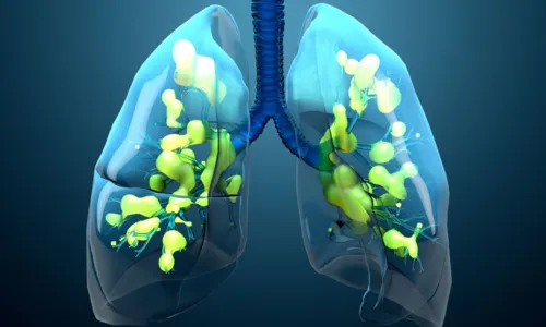 
				
					Quase 2 mil pessoas já morreram com pneumonia na Bahia em 2024
				
				