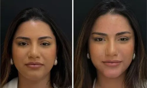 
				
					Namorada de Luva de Pedreiro faz harmonização facial; veja resultado
				
				