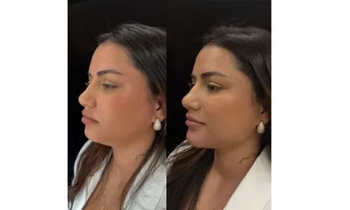 
				
					Namorada de Luva de Pedreiro faz harmonização facial; veja resultado
				
				