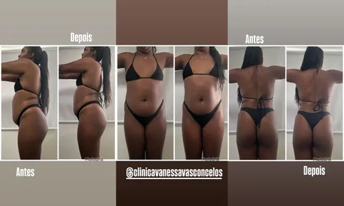 Raquel Brito rebate críticas após procedimento estético: 'Corpo real'
