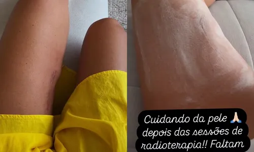 
					Vera Viel revela reações a radioterapia e desabafa: 'Tenho sofrido'
				
				