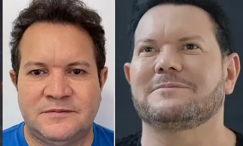 
				
					Ximbinha fica irreconhecível após nova harmonização facial; veja
				
				