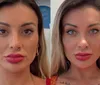 Andressa Urach passa por procedimento e surge com rosto ensanguentado