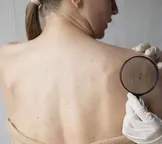 Mutirão de prevenção e detecção de câncer de pele é realizado na Bahia