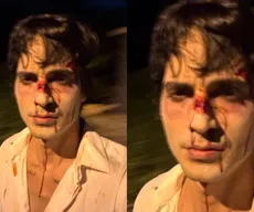 Fiuk assusta ao aparecer com o rosto todo machucado e sangrando