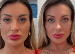 Andressa Urach passa por procedimento e surge com rosto ensanguentado