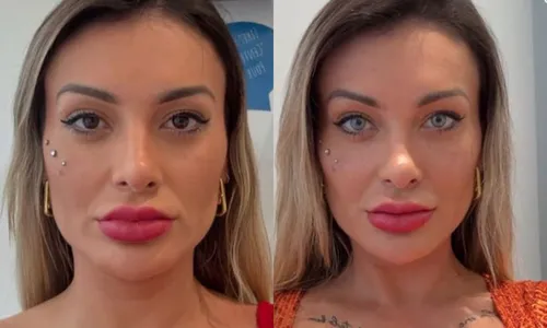 
					Andressa Urach passa por procedimento e surge com rosto ensanguentado
				
				