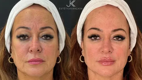 
				
					Antes e depois: mãe de Neymar gasta R$ 25 mil em transformação visual
				
				
