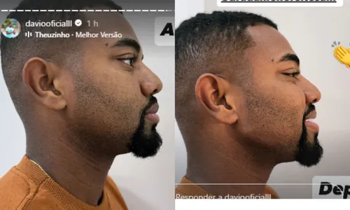 
				
					Davi Brito faz novo procedimento estético e mostra antes e depois
				
				