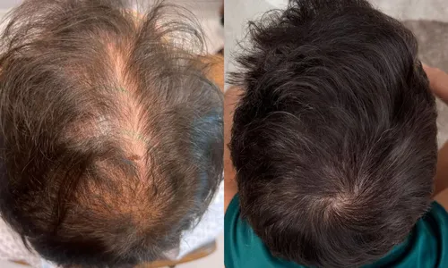 
				
					Ex-BBB Gustavo radicaliza em transformação visual; veja antes e depois
				
				