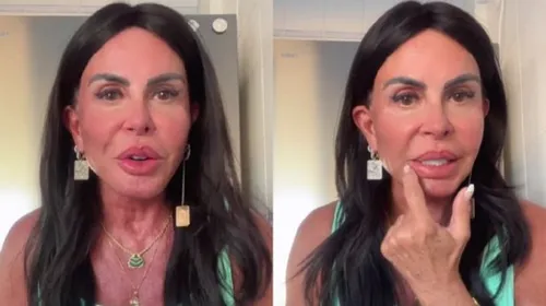 
					Gretchen reverte harmonização facial e emagrece 10 kg; antes e depois
				
				