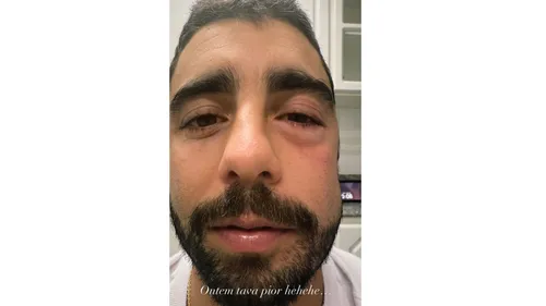 
					Pedro Scooby aparece com o rosto inchado e preocupa fãs
				
				