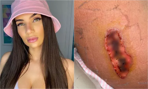 
					Stéfani Bays passa por múltiplas cirurgias após queimadura com bisturi
				
				