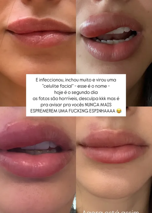 
					Bruna Biancardi assusta ao revelar infecção no rosto
				
				