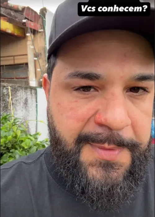 
				
					Cantor Léo mostra rosto após ser atingido por fogo em show
				
				