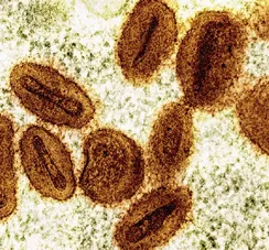 Bahia tem dois casos de Mpox confirmados em 2026