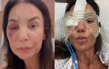 Ivete Sangalo surge com equipamento inusitado no rosto em recuperação