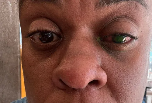 
					Cacau Protásio perde visão após uso de pomada e assusta fãs: 'Dor'
				
				