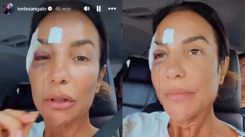 
					Ivete Sangalo surge com equipamento inusitado no rosto em recuperação
				
				