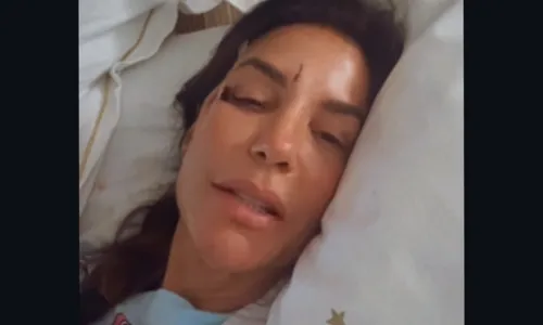 
					Ivete Sangalo surge com forte hematoma para show após grave acidente
				
				