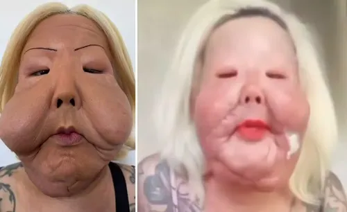 
					Juju do Pix exibe rosto após cirurgia delicada para tirar óleo mineral
				
				