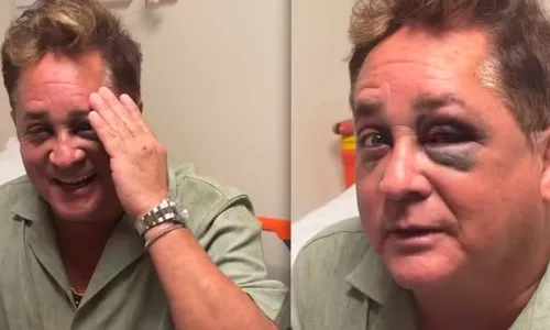 
					Leonardo sofre acidente e surge com olho deformada; saiba estado
				
				