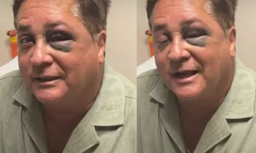 
					Leonardo sofre acidente e surge com olho deformada; saiba estado
				
				