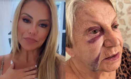 
					Sogra de Leonardo sofre acidente em casa e rosto fica desfigurado
				
				