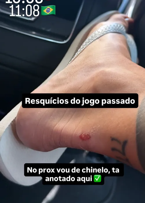 
					Virginia expõe ferimento causado durante jogo do Brasil: 'Resquícios'
				
				