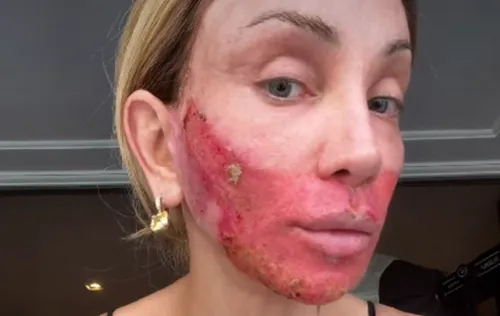 
					Maya Massafera assusta após novo procedimento: 'Está em carne viva'
				
				
