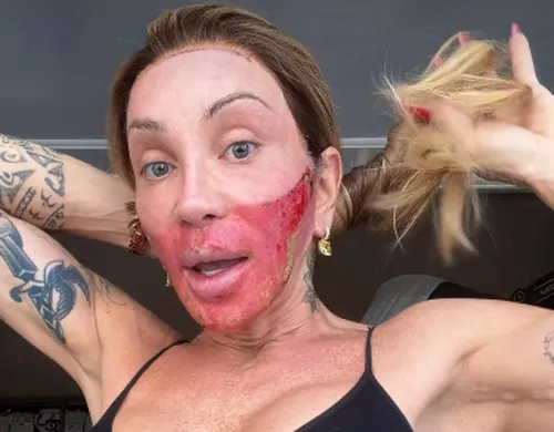 
					Maya Massafera assusta após novo procedimento: 'Está em carne viva'
				
				