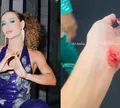 Dança dos Famosos: Bruna Griphao assusta ao mostrar braço machucado