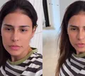 Quanto custou procedimento de Simone Mendes no nariz? Especialista faz ressalva